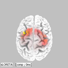 Neuroffedback, QEEG ve Psikolojik Test Merkezi # 10 sloreta localization:/ sloreta yerleşimi Brodmann area 6(Middle Frontal Gyrus, Frontal Lobe) /Brodmann alanı 6 ( Orta ön beyin kıvrımı, ön lob) 2.
