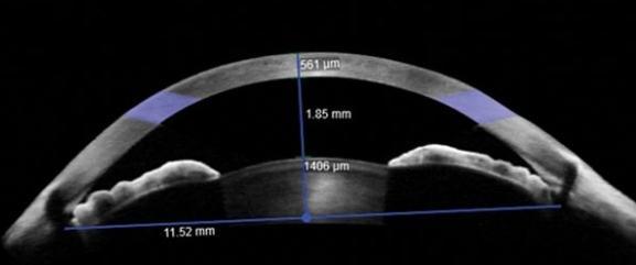retina kalınlığı ölçümü Peripapiller sinir lifi katı