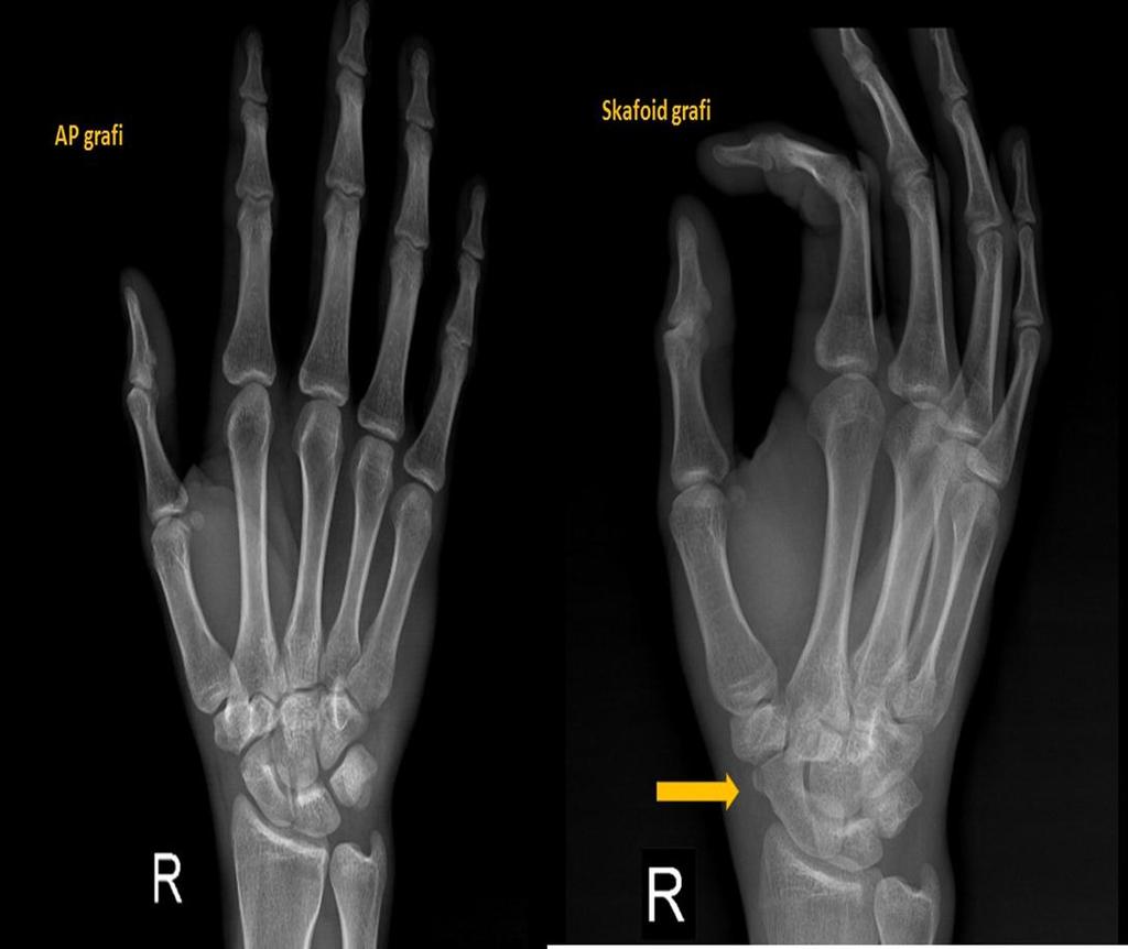 SKAFOİD KIRIĞININ ATLANMASI Skafoid değerlendirilmesinde standart AP/obliq grafiler yeterli değildir.