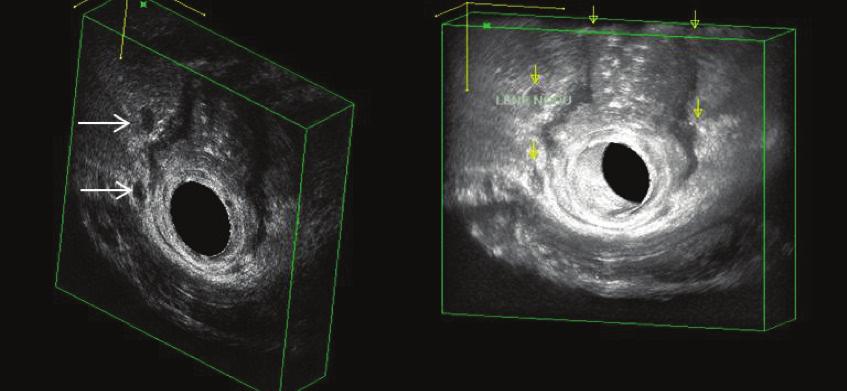 ut0 ut1 ut2 ut3 ut4 un0 un1 Villöz adenom Tablo I: Ultrasonografik TN sınıflaması (1) Sadece mukoza ve submukoza (orta hiperekoik katman sağlam) Muskularis propria tutulmuş (3.