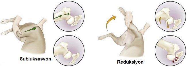 sağlamak için basınç uygulanır. Sublukzasyona uğrayan caput femoris in asetabulum a yerleģmesini sağlamak için 15-20 derece abduksiyon yaptırılır (Piermattei ve Flo, 1997; Adam ve ark.
