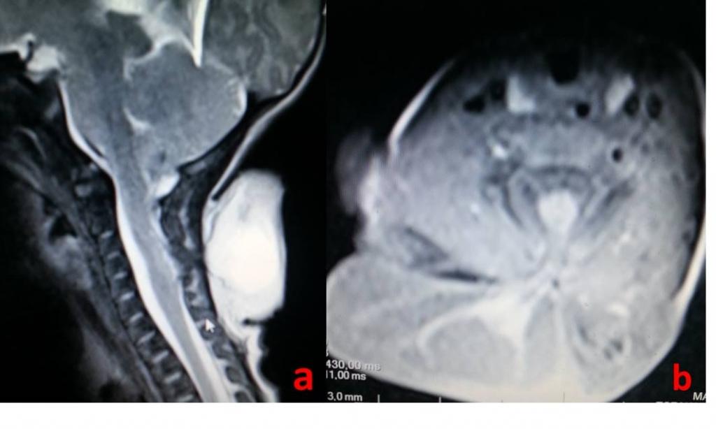 Çekilen servikal MR ında nöral yapı içeren meningomiyelosel kesesi görüldü (Şekil 2a,b).