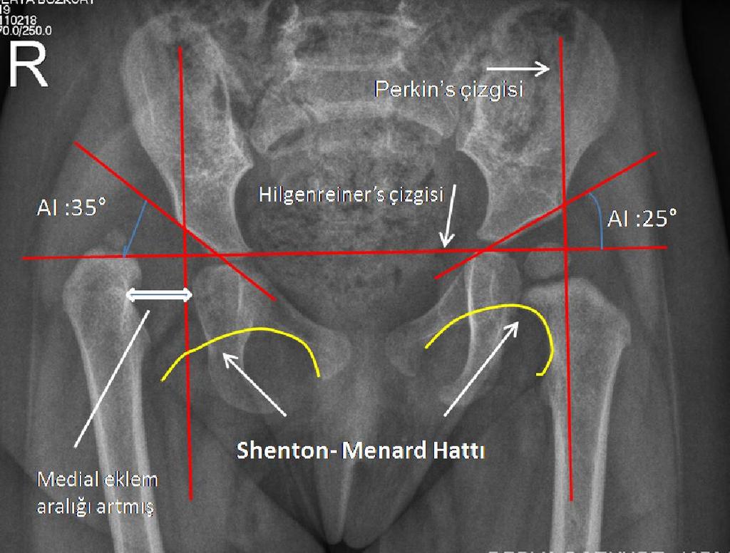 Von Rosen II Belirtisi: Sırtüstü yatar pozisyonda kalçalar 45 abdüksiyon ve 25 iç rotasyonda iken çekilen grafide femur uzun ekseni çizgisi, normalde asetabulumdan geçerken, çıkık olan kalçada bu