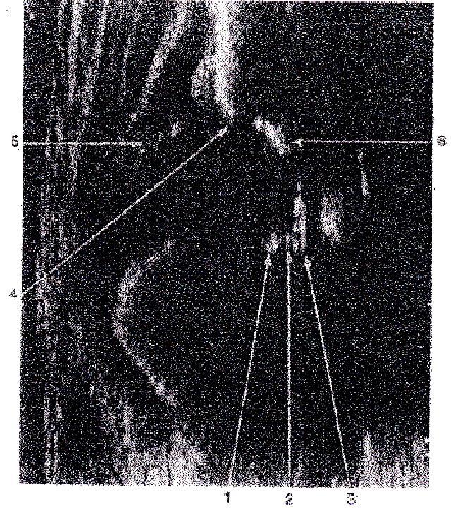 1- Ligamentum teres 2- Pulvinar 3- Perikondriyum 4- Asetabuler kemik kenar 5- Eklem kapsülü 6- İliumun alt sınırı Şekil-15: İnfant kalça eklemi sonogram görüntüleri (33) Labrum: Asetabulumun