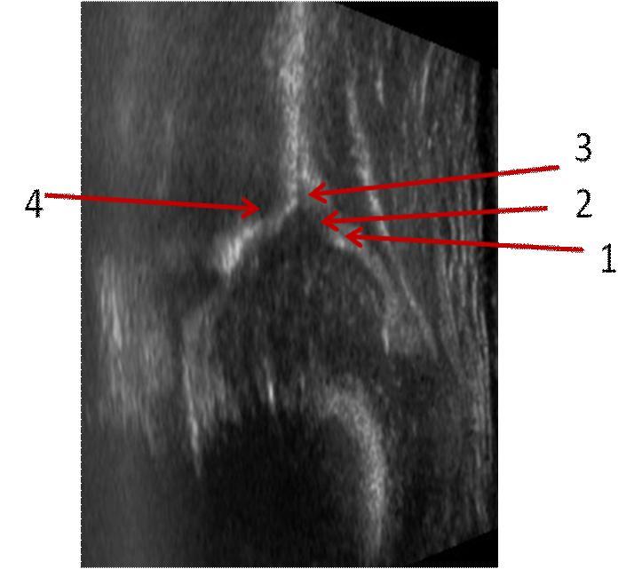 Bundan dolayı kalça ultrasonografisinde perikondrium boşluğu olarak adlandırılır (Şekil-16). 1. Asetabuler labrum 2. Perikondriyal aralık 3. Proksimal perikondriyum 4.