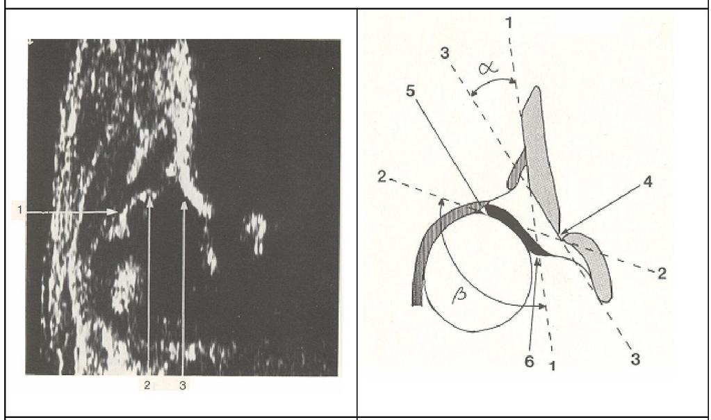 1-Eklem kapsülü 2-Labrum 3-Kemik köşe 1-Baseline 2-Kıkırdak çatı çizgisi beta açısı 3-Kemik çatı çizgisi