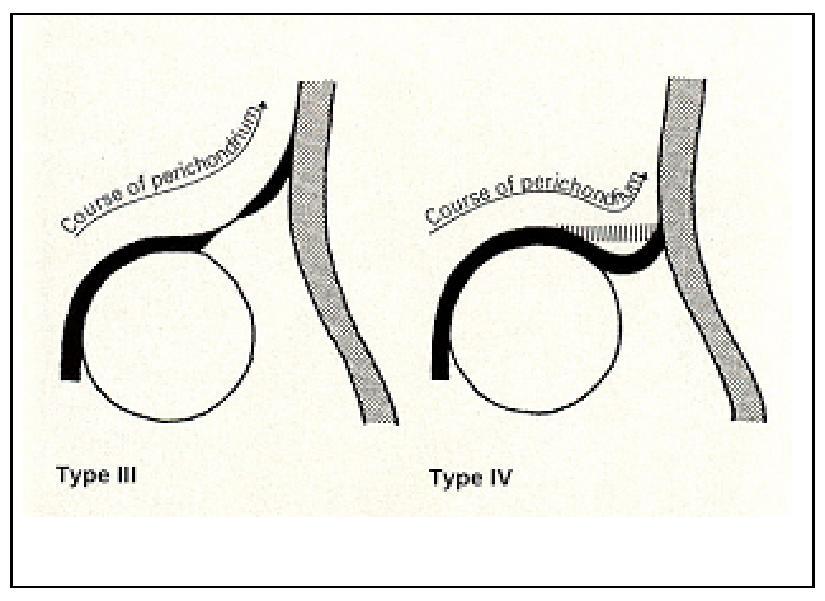 Tip 3 ve Tip 4 Kalçanın Ayırımı: Tip3 ve Tip4 kalçalarda standart görüntü (referans noktalar) elde etmek zordur. Bu nedenle perikondriyumun morfolojik yapısına bakılarak tiplendirme yapılır (7).