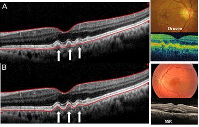 epiretinal zar, arka vitreus dekolmanı İç