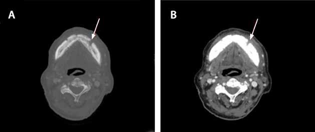 Zor Tanı Kolay Tedavi: Aktinomikoz Resim 1. 2 numaralı olgumuzda mandibula tutulumu (serviko-fasiyal tip aktinomikoz).