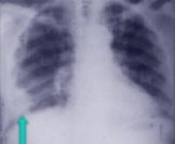 FM: Ateş:38.2 o C, N:80/dk, KB: 120/75mmHg Bilinç açık, koopere, oryante hasta.