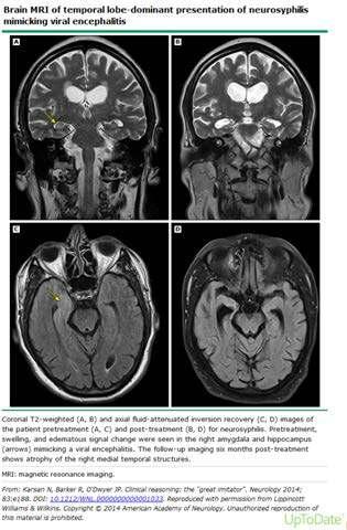 Otoimmun/herpes ensefalit benzeri klinik Budhram A, et al, Neurosyphilis mimicking autoimmune encephalitis in a