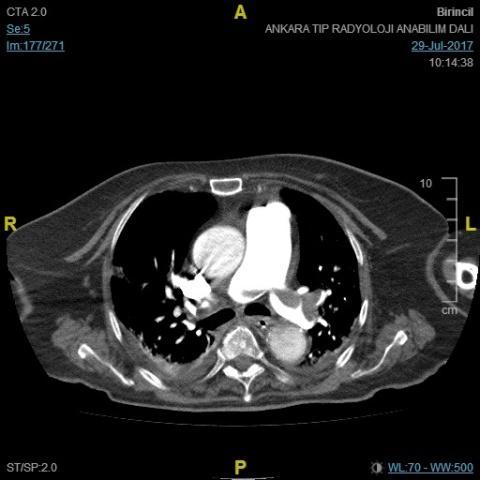 D-dimer : 2382 Cre:1.