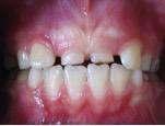 OLGU 3 (Süpernümerer Dişe Bağlı Persiste Süt Dişi) 10 yaşındaki kız çocuğu maksiller kesici dişlerinin değişmemesi şikayetiyle kliniğimize başvurdu (Resim 3a).