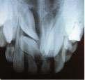 Süpernümerer dişler alındı. Kesici dişlerin kök uçları radyografik olarak kapanmış görünmesine rağmen yaklaşık dört ay sonra 21 no lu dişin erüpsiyon görüldü (Resim 4c).