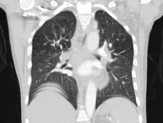 Thorax Tomografi Bilateral akciğer üst loblarda milimetrik boyutlu yer