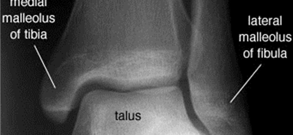 Ayak bileği Mortis görüntüsü Dizilim ve Stabilitenin Radyolojik Ölçümleri Yaralanma ve redüksiyon sonrası yapılan radyolojik incelemelerle dizilimin