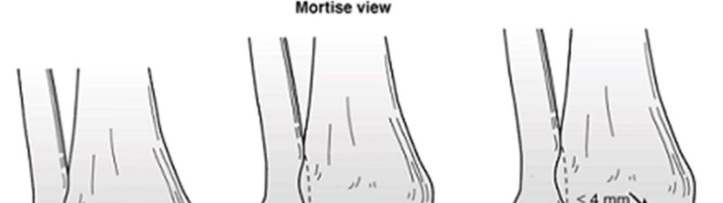 21 c)medial aralık Mortis grafisinde medial malleolün lateral sınırı ile talusun medial sınırı arasındaki mesafedir.