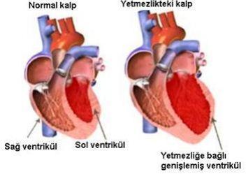 Sol kalp yetmezliğinde pulmoner semptomlar ön planda.