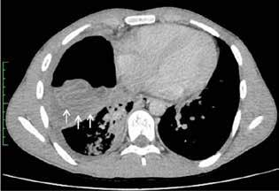 3) Toplam 28 A B C Şekil 1: Serebral kist hidatik nedeniyle opere edilen 10 yaşındaki erkek çocuğa ait arka-ön akciğer grafisinde