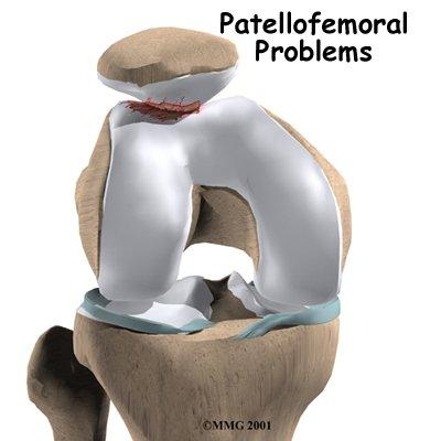 Patellofemoral ağrı