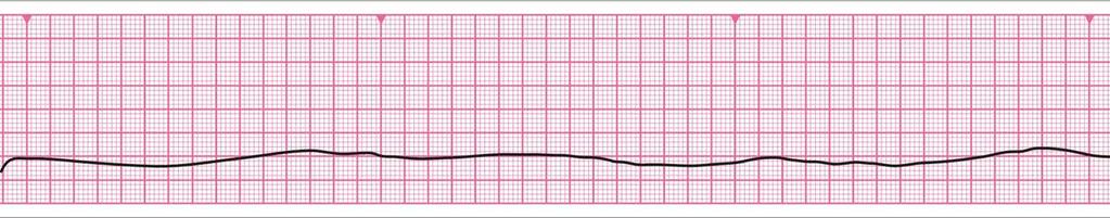 Ventriküler (QRS) aktivite yok Atriyal aktivite (P dalgaları)