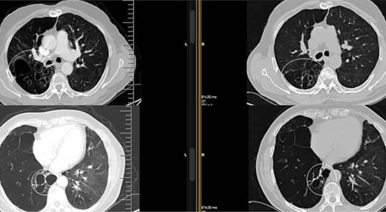 küçülme, mediastinal organların sağ tarafa yer değiştirme gözlenmektedir.