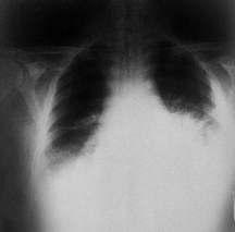 Akciğer Şarbonu Lenf düğümlerinde hemorajik nekroz 2 5 gün içinde hafif ateş, kırgınlık ve yorgunluk şikayetleri ile başlar Ateş,