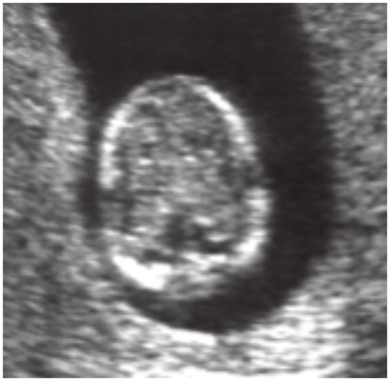 Fetal Yapısal Anomali Taraması Tablo 1 Fetal Anomalilerin Saptanması için 11-14. Gebelik Haftalarındaki Ultrasonografinin Doğruluğu.