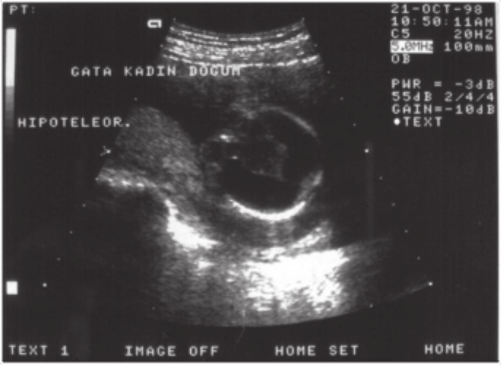 Fetal Yapısal Anomali Taraması Sisterna Magna, serebellumun posterior kısmında yer alır ve posterior fossa olarak tanımlanmaktadır.