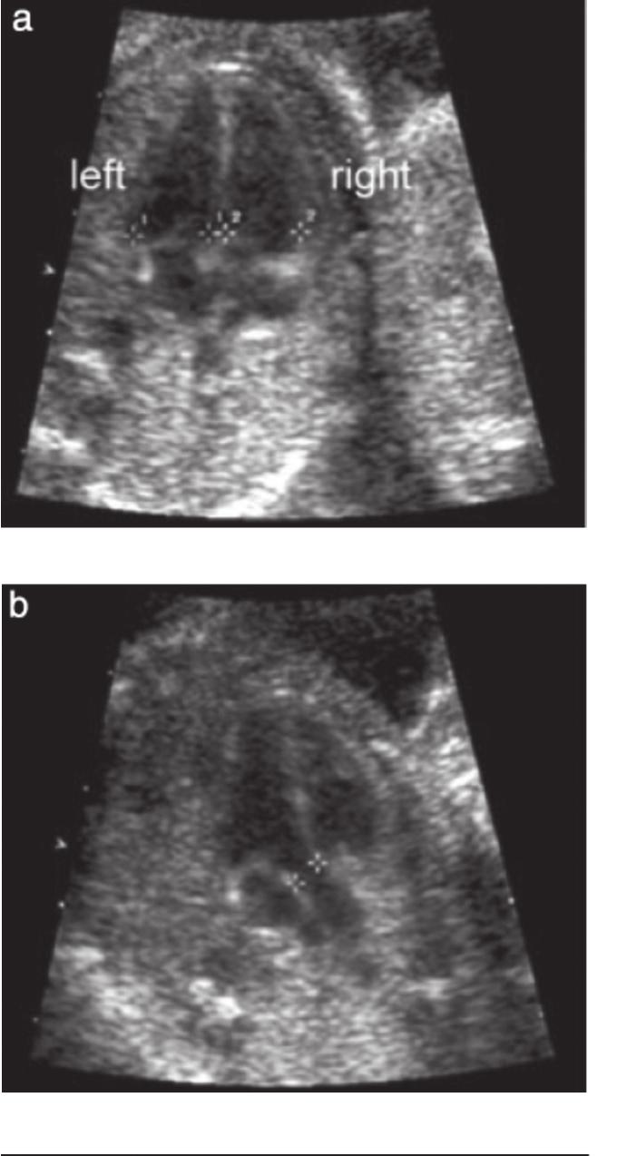 Fetal Yapısal Anomali Taraması 4 odacık Görünümü Büyük Damar Çıkışı (PulmonerArter) Büyük Damar Çıkışı (Aorta) Üç Damar Görünümü Resim 12.