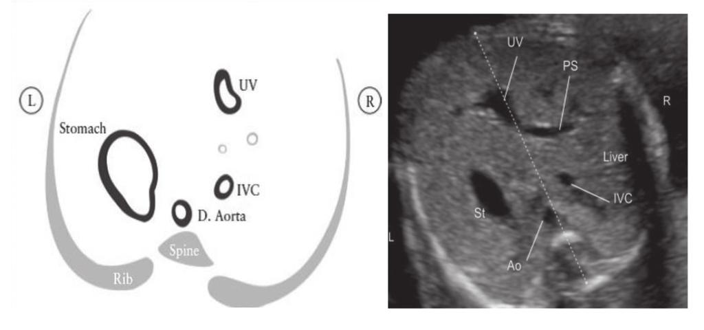 Gebelikte Tarama ve Öngörü D. aorta: desendan aorta, Stomach: mide, IVC: inferior vena kava, UV: umblikal ven Şekil 3.