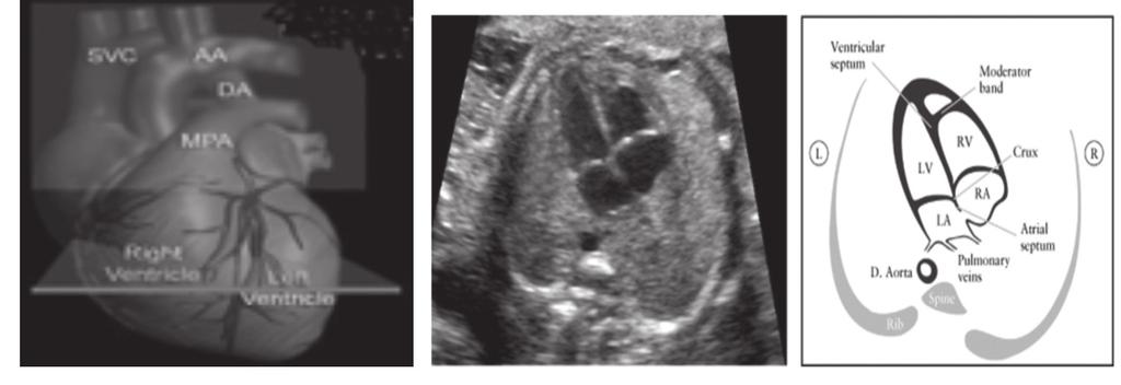 Fetal Kalp Taraması SVC: süperior vena kava, MPA: anapulmonerarter, DA: duktus arteriyozus AA: Asendan aorta, LA: sol atriyum, RA: sag atriyum, LV: sol ventrikul, RV: sağventrikul Şekil 4.