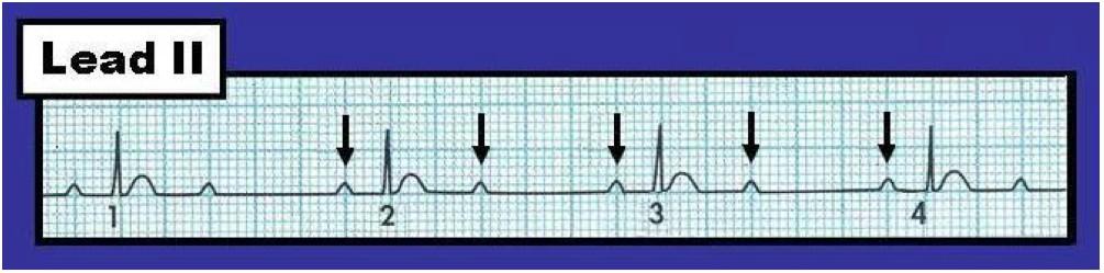 III. AV blok Atrial aktivite ventriküllere iletilmez Atrium ve ventriküller birbirinden bağımsız pacemaker ile kontrol edilir Hem P hemde QRS var fakat birbirinden
