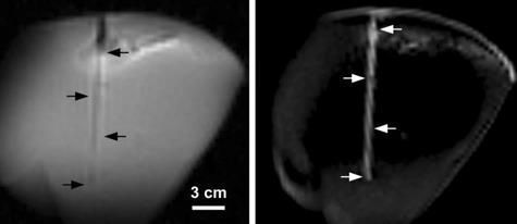 Susceptibility Artifact) Small iron coating on plastic