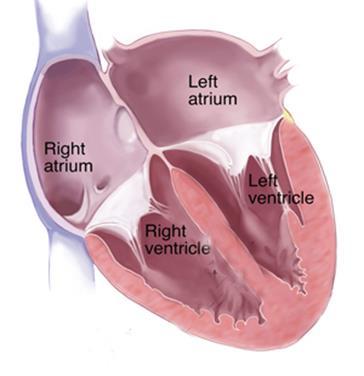 Gözlemler: 1. Complete acute recoil of interventricular septum 2.