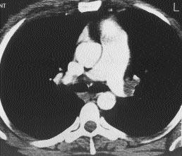 Resim 3. Sol ana pulmoner arter distalinde emboliye ait hipodens dolum defekti mevcuttur. ana bronş duvar nda kal nlaşma ve mediastende çok say da lenfadenopati izlendi.