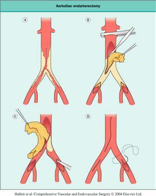 Aortobifemoral bypass