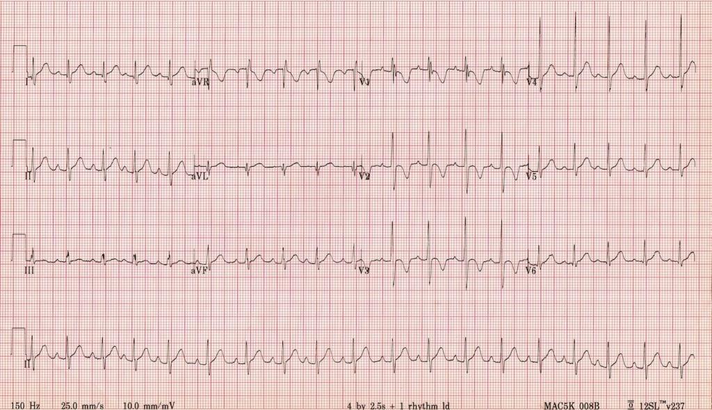 Örnek Olay 1-EKG Raporunu Okuyamayan Hekim Özel bir hastanenin acil servisinde görevli bir acil servis hekimi hastanın Miyokard İnfaktüsü (MI) çok açık bir şekilde belli olduğu EKG raporunu doğru bir