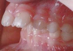 Protruzif Keser Pozisyonu Dental Travma Yetersiz Dudak