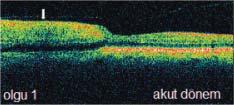 Retina kalınlığı 550 μm idi.