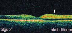 OCT incelemesinde, üst perifoveolar alanda iç retina tabakasının reflektivitesinde artma ve retinada kalınlık artışı