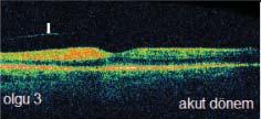 FRT ve RPE koryokapillaris kompleksi reflektivitesinin azaldığı görüldü. Olgunun 1.