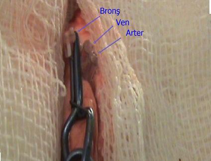 Donör Akciğerin çıkarılması ve Cuff lama işlemi: Sol akciğer laterale retrakte edilerek sol hiler yapılar açığa çıkarılır. Bu sırada inferior ligaman serbestlenir ise yapılar daha net ortaya konur.