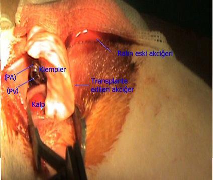 Ardından toraksa göğüs tüpü konularak tüm kas katları 5-0 vicril sütür (Dogsan, Pegelak ) anatomik planda kapatılır (Resim 12). Resim 11.