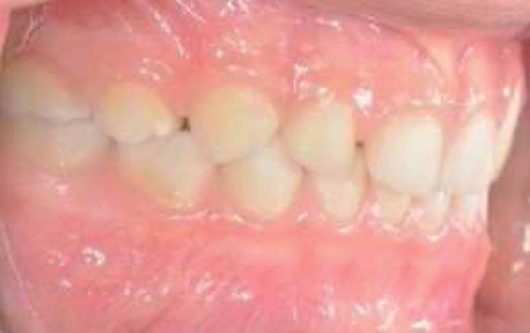 ŞEKİL 15: Süt dişlenme döneminde görülen düz okluzal düzleme ait ağız-içi görüntü. dişlerinin sürmesiyle başlar, erken (birinci) ve geç (ikinci) olmak üzere iki dönemde tamamlanır.