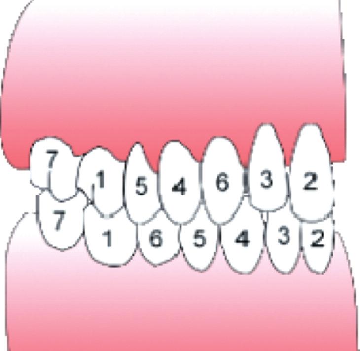 2-6 yaş arasında ön bölgede transversal ve sagittal yön boyutları hemen hemen aynı kalırken, arka tarafta süt diş kavsi genişliği 1 mm artmaktadır ve bu durum daimi dişler için yer sağlamaktadır.