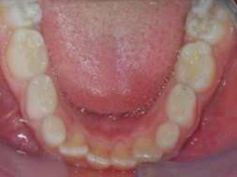 8 İkinci okluzyon kilitlenmesinin oluşumunda süt dişlerinin zamanla okluzal yüzlerindeki aşınmalar (Şekil 21) da etkili olmaktadır.