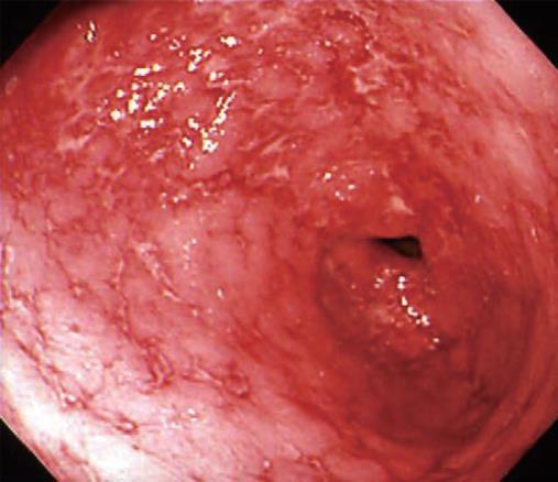Gastrit 31 yaş erkek bir aydır olan hafif ateş ve epigastrik