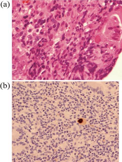 Cytomegalovirus-associated Acute Gastric Mucosal Lesion in an
