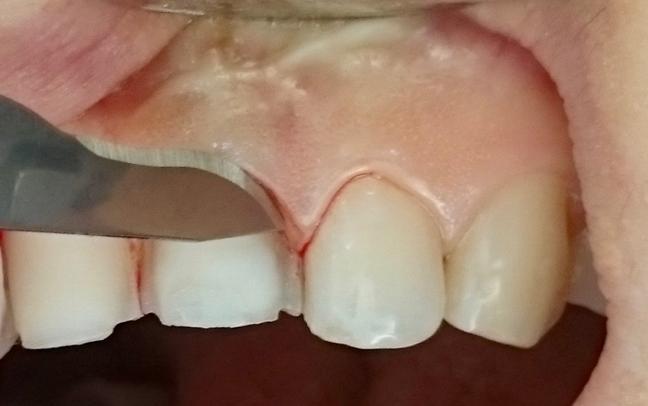 Ancak kontak bölgelerinde linguale doğru doğal diş kontaklarının korunması istenir. Böylece dişlerin pozisyonları korunur ve migrasyonları engellenmiş olur.
